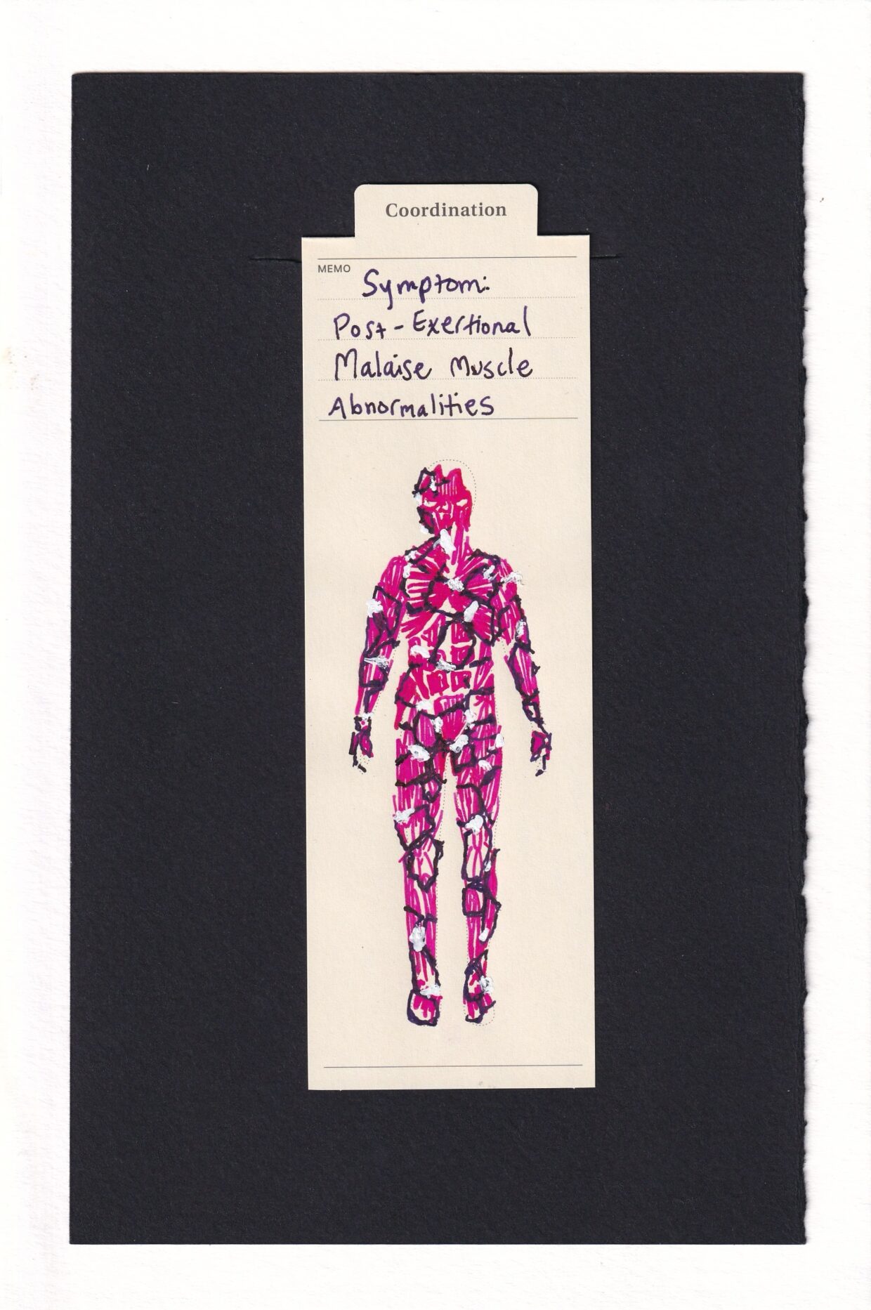 Front view of a person's musculature. Cell-like shapes and partial cell-like shapes in dark purple are drawn over parts, and some of them have white out swelling over them. These are references to the linked study's figures showing what it looked like under microscope.